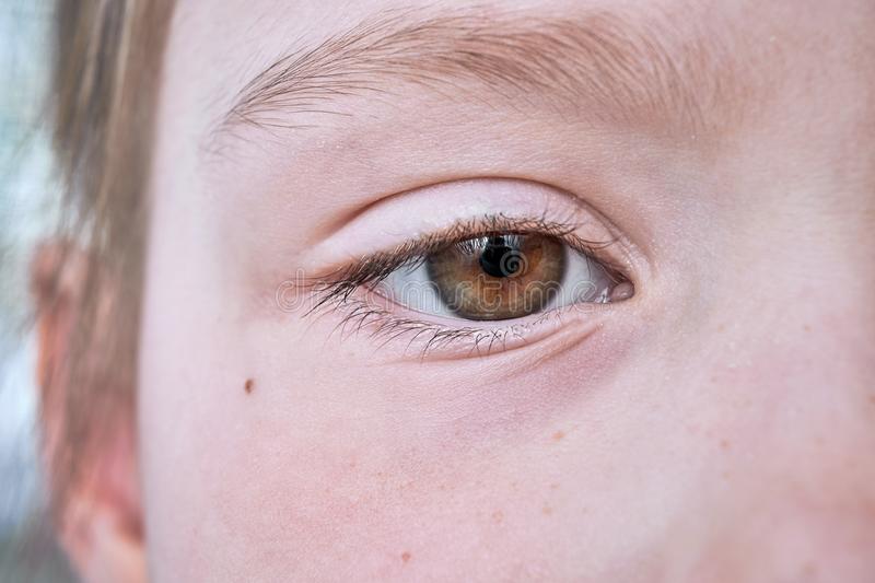 Nếu muốn xóa nuốt ruồi ở mắt thì bạn đọc nên tìm hiểu và cân nhắc kỹ càng