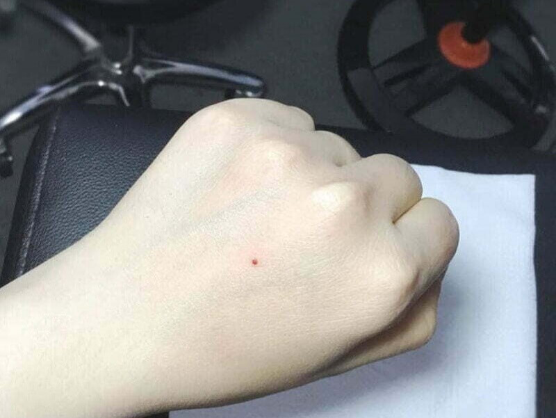 Nốt ruồi son trên bàn tay có ý nghĩa gì?