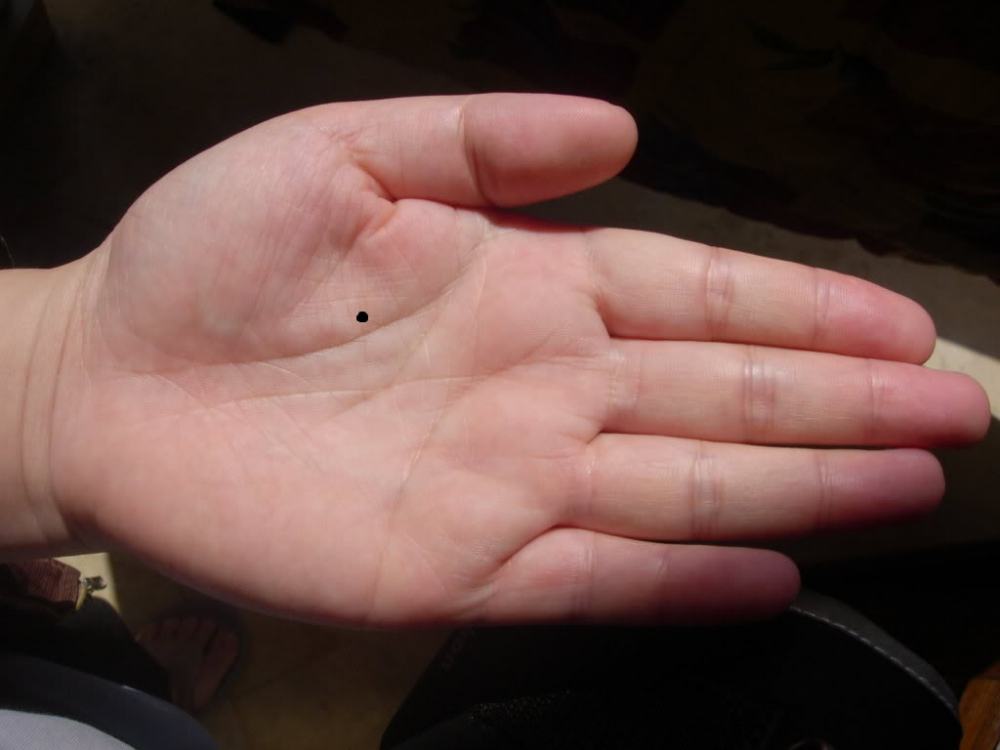 nốt ruồi trên bàn tay