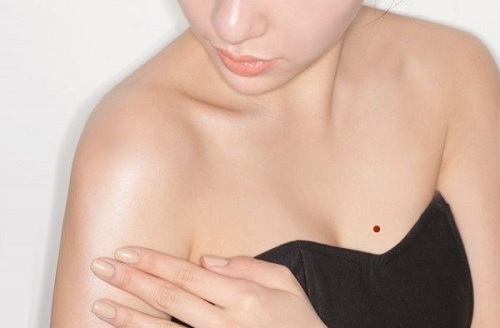 Nốt ruồi mọc ở phía trên bầu ngực